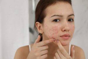 Donna con brufoli sul viso